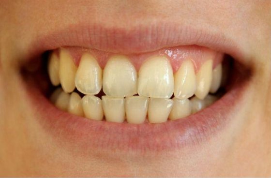 Teeth before whitening