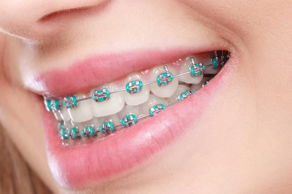 Close-up of a smile with braces