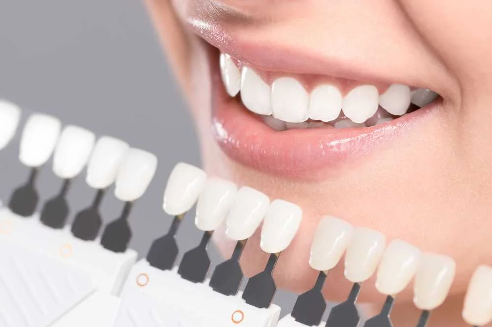 Smile next to a dental shade guide