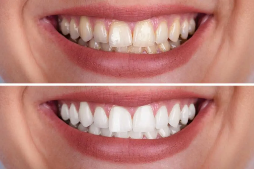 Teeth before and after whitening, one above the other