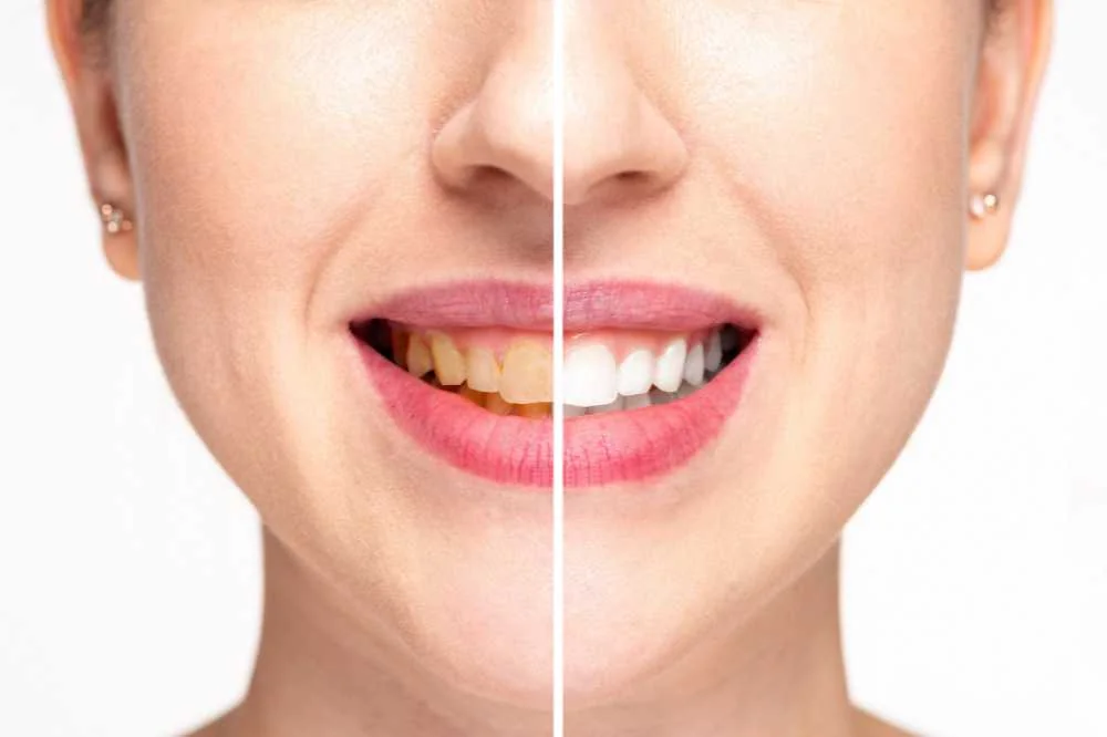 Smile split down the middle, yellow teeth on the left and white teeth on the right
